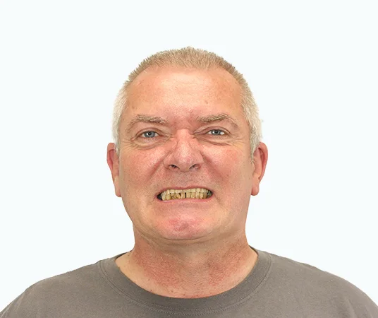 Фото: до имплантации зубов