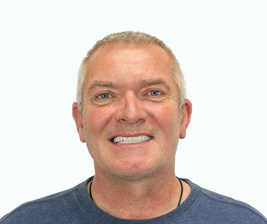 Фото: после имплантации зубов