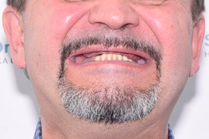 All-on-4 с двумя имплантами Zygoma для верхней челюсти, фото до