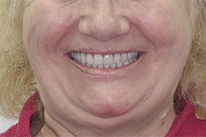 Восстановление зубов All-on-6 и All-on-4
