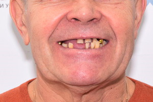 All-on-6 для восстановления зубов на обеих челюстях, фото до
