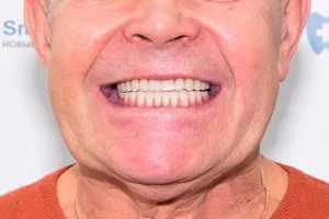 All-on-6 для восстановления зубов на обеих челюстях, фото после