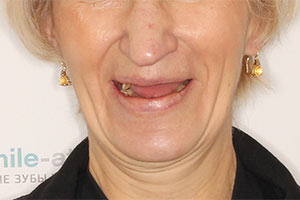 Комплексное восстановление зубов на 2 челюстях