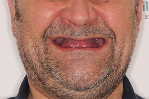 Отсутствие зубов на обеих челюстях