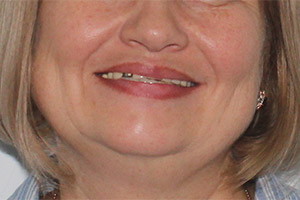 Базальные импланты верхней челюсти