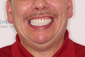 Имплантация после ношения зубных коронок