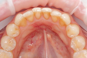Ежегодная гигиена полости рта для профилактики кариеса, фото до