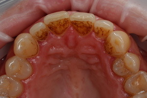 Комплексная чистка зубов, фото до