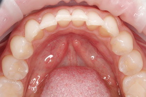 Ежегодная гигиена полости рта для профилактики кариеса, фото после