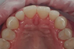 Комплексная чистка зубов, фото после