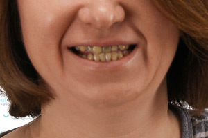 Красивая улыбка в комплексе: коронки и имплантация зубов