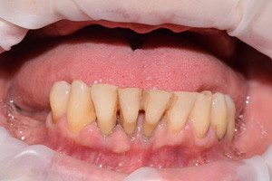 Базальная имплантация для восстановления зубов на верхней и нижней челюсти