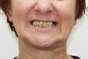 Восстановление зубов верхней челюсти