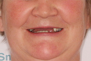 Восстановление разрушенных зубов 2х челюстей