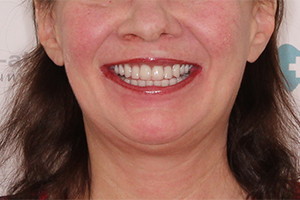 Полное отсутствие зубов двух челюстей