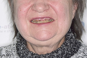 Разрушенные зубы верхней челюсти