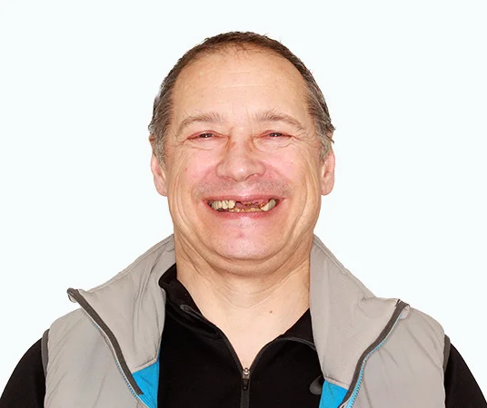 Фото: До имплантации