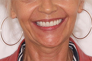 Восстановление зубов на двух челюстях