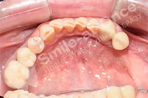 Имплантация отсутствующих жевательных зубов