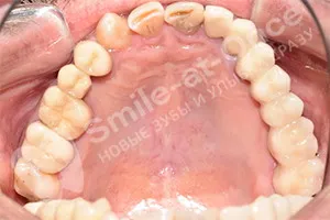 Имплантация отсутствующих жевательных зубов