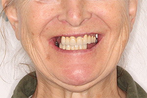 Восстановление разрушенных зубов