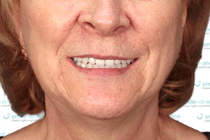 Полное восстановление зубов all-on-4 ПОСЛЕ