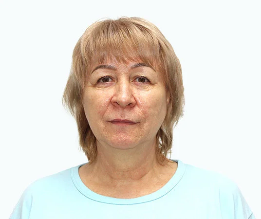 Фото до имплантации зубов