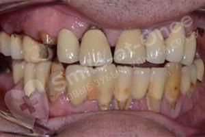 До имплантации зубов методом All-on-6