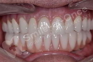 После имплантации зубов методом All-on-6