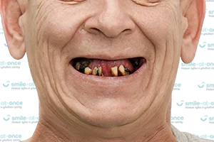 All-on-4 за 3 дня при сильном разрушении зубов ДО