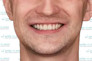 Все зубы all-on-6 за 1 день недорого ПОСЛЕ