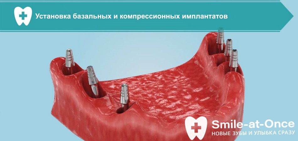 Видео о лучших методах имплантации при атрофии кости