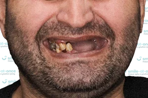 Все зубы Pro Arch на 6 имплантах Straumann ДО