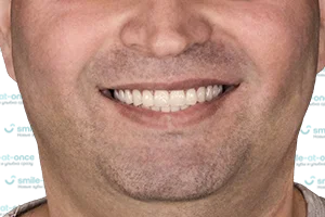 Все зубы Pro Arch на 6 имплантах Straumann ПОСЛЕ