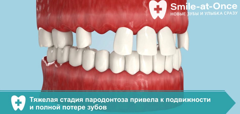 Видео об особенностях протезирования All-on-6 на верхней челюсти