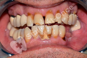 Базальная имплантация всех зубов