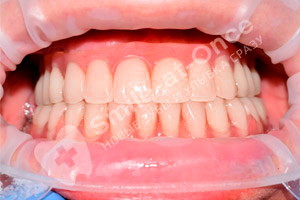 Восстановление зубов на обеих челюстях