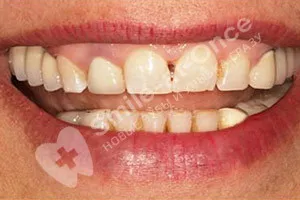 Классическая имплантация жевательных зубов