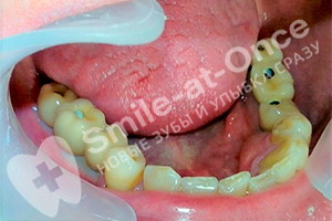 После имплантации жевательных зубов