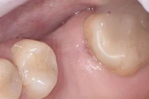 Имплантация жевательного зуба ДО