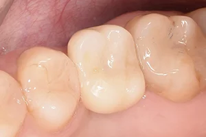Имплантация жевательного зуба ПОСЛЕ