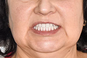 Все зубы All-on-4 с бескаркасным протезом ПОСЛЕ