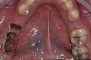 Имплантация Straumann для нескольких зубов ДО