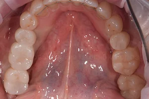 Имплантация Straumann для нескольких зубов ПОСЛЕ
