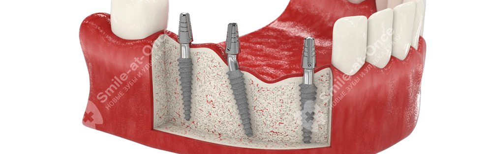Имплантация зубов «под ключ»