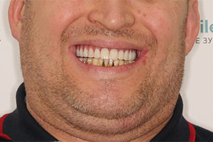 Восстановление верхней челюсти базальными имплантами фото ПОСЛЕ
