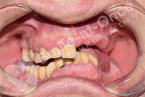 Восстановление зубов на 2 челюстях