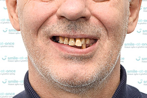 All-on-4 Nobel Biocare – все зубы за 1 день ДО