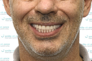 All-on-4 Nobel Biocare – все зубы за 1 день ПОСЛЕ