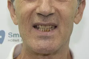 Восстановление зубов методом All-on-4 - до